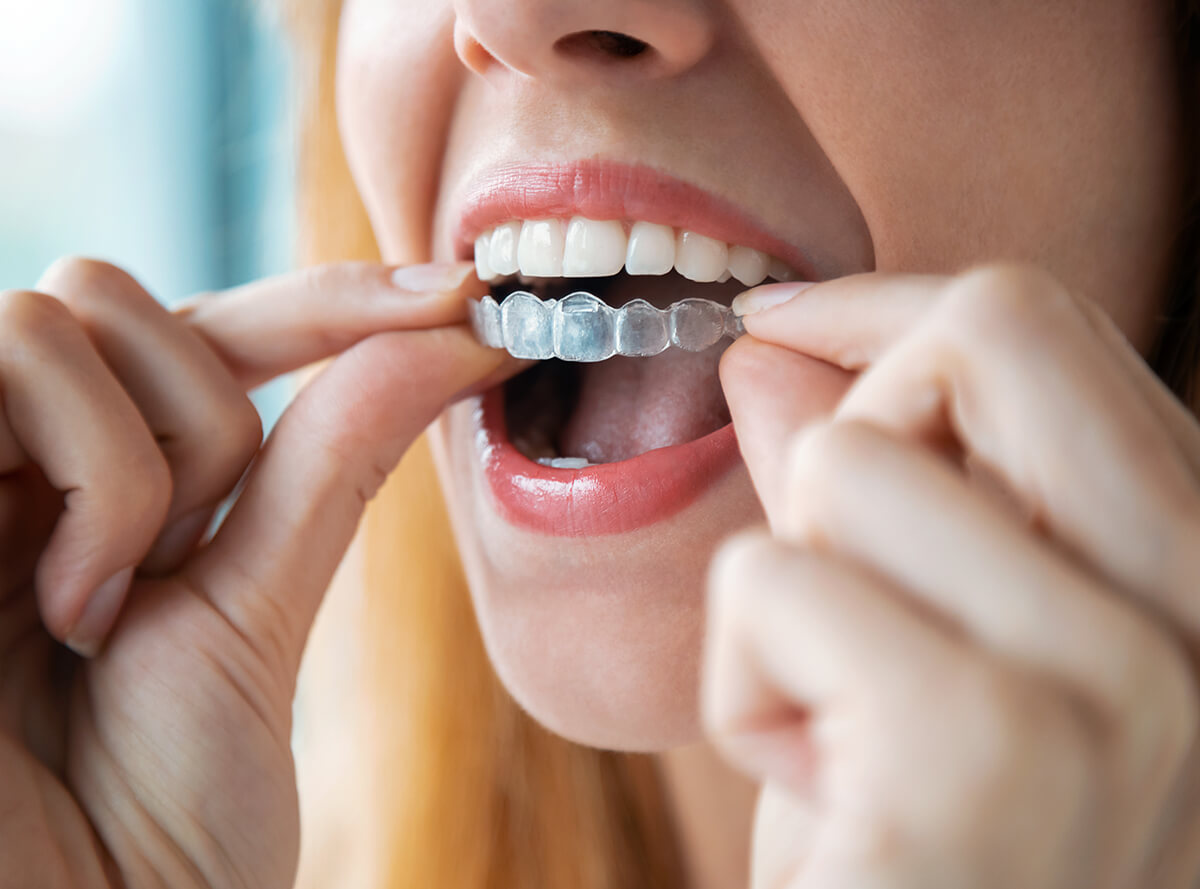 Teeth Straightening With Invisalign Clearwater Discrete Straightening